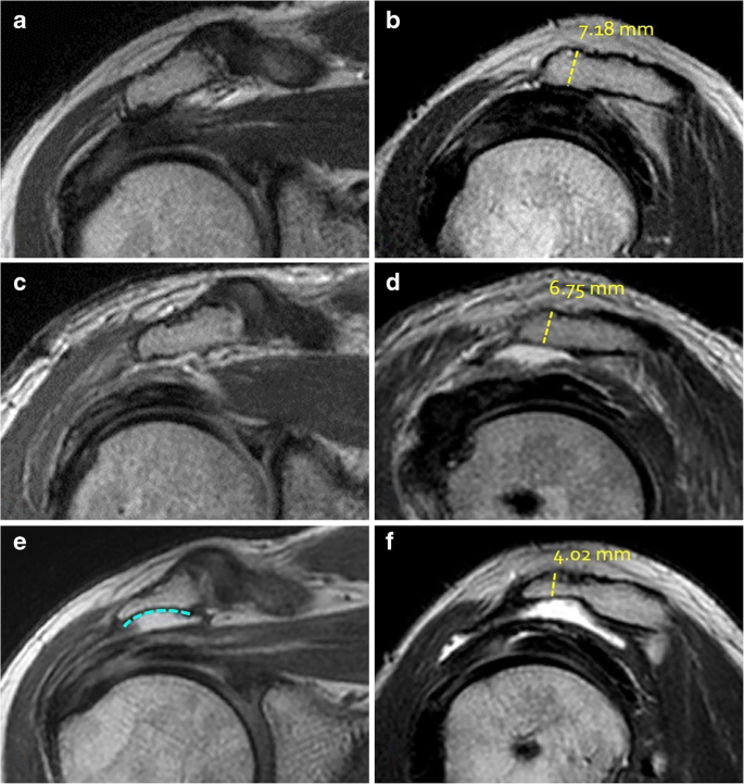 Assessment of postoperative acromial and subacromial morphology after  arthroscopic acromioplasty using magnetic resonance imaging | Skeletal  Radiology