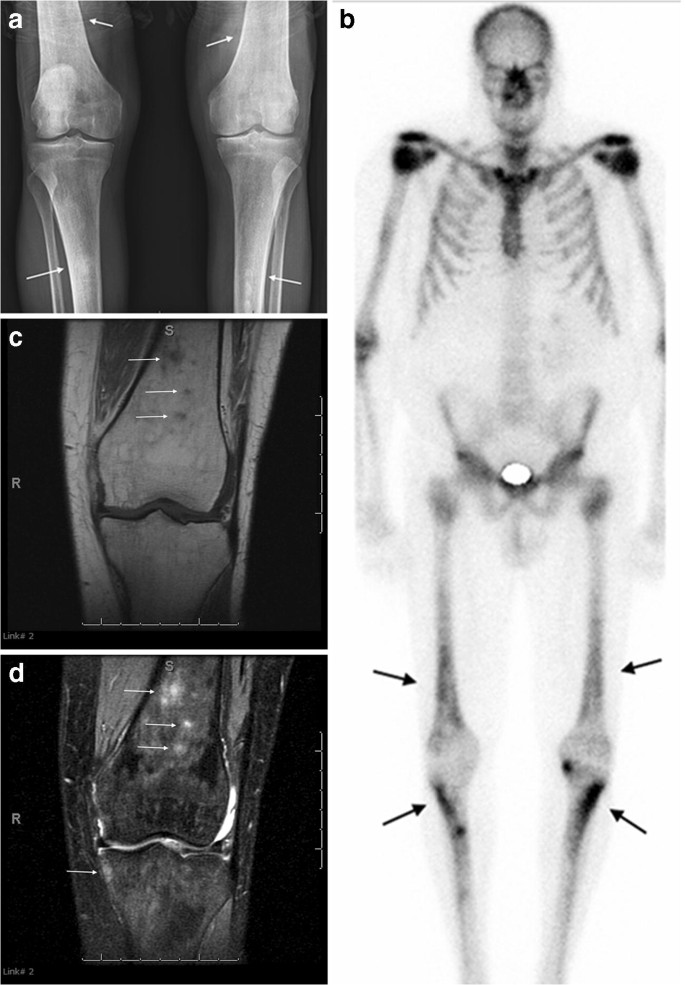 Sclerotic Bone Lesions Caused By Non Infectious And Non Neoplastic Diseases A Review Of The Imaging And Clinicopathologic Findings Springerlink