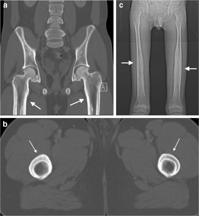 Sclerotic Bone Lesions Caused By Non Infectious And Non Neoplastic Diseases A Review Of The Imaging And Clinicopathologic Findings Springerlink