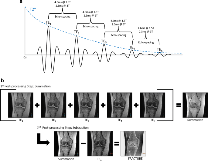 Fast field echo resembling a CT using restricted echo-spacing (FRACTURE): a  novel MRI technique with superior bone contrast | SpringerLink