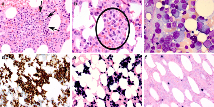 Plasma cell neoplasms and related entities—evolution in diagnosis and  classification | Virchows Archiv