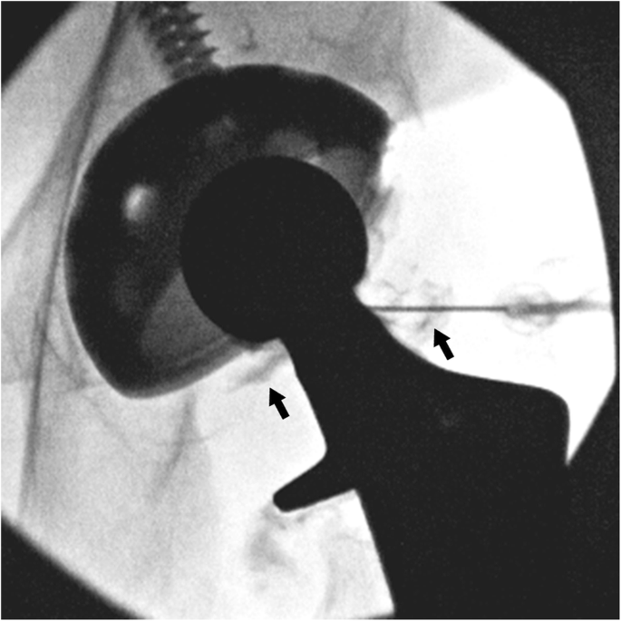 Diagnostic Value Of Fluoroscopy-Guided Hip Aspiration For Periprosthetic  Joint Infection | Springerlink