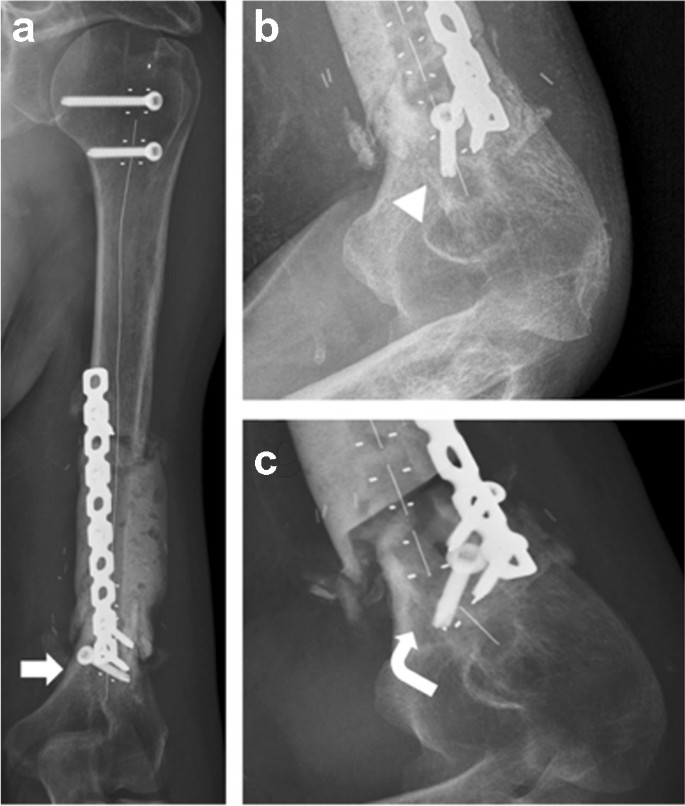 Clinical details: (a) X-ray: implant failure with subsequent plate