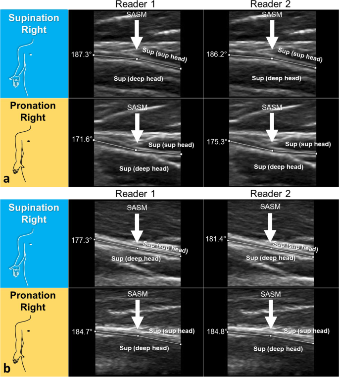 Pronation-supination movement angle.