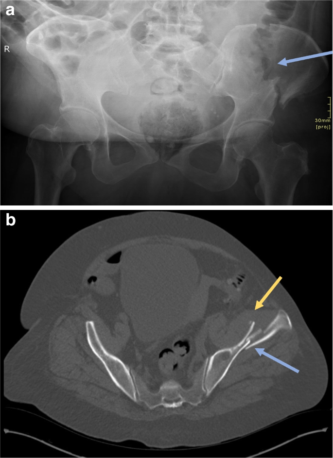 Severe atypical iliac wing fracture associated with long-term ...