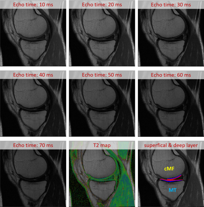 Evaluation of an automated laminar cartilage T2 relaxation time ...