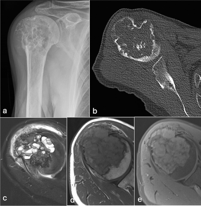 Test yourself question: 67 year old male with worsening right shoulder ...