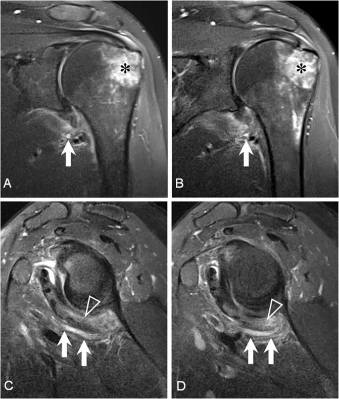 Magnetic resonance imaging features of axillary nerve injuries ...