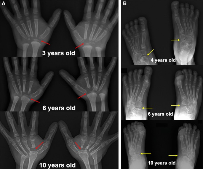 Multicentric carpo-tarsal osteolysis: the importance of imaging studies ...