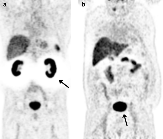 68Ga-PSMA PET/CT: Joint EANM and SNMMI procedure guideline for ...