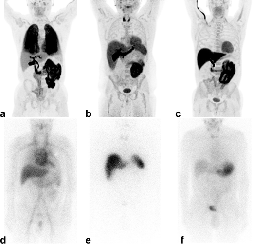 Extracardiac 18F-florbetapir imaging in patients with systemic ...