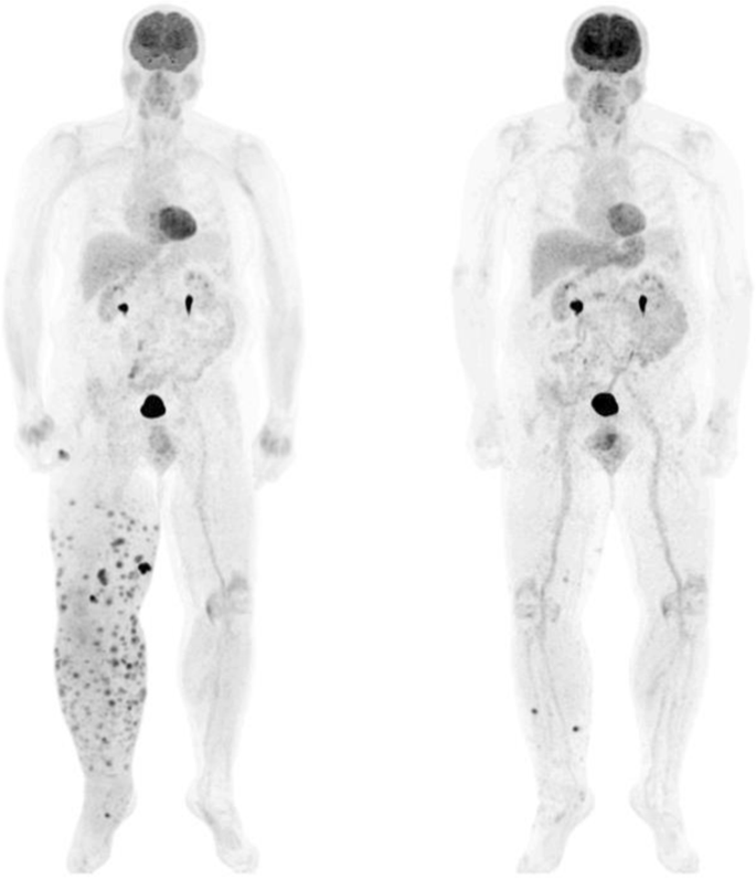 Monitoring Response Of Advanced Merkel Cell Carcinoma To Avelumab With 18 F Fdg Pet Ct Springerlink