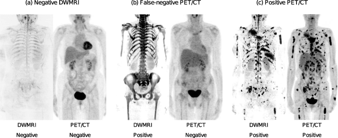Low hexokinase-2 expression-associated false-negative 18F-FDG PET/CT as a  potential prognostic predictor in patients with multiple myeloma |  SpringerLink