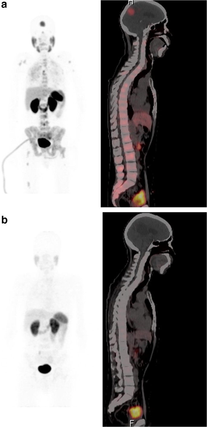 Treatment Of Brain Metastases Of Castration Resistant Prostate Cancer With 225 Ac Psma 617 Springerlink