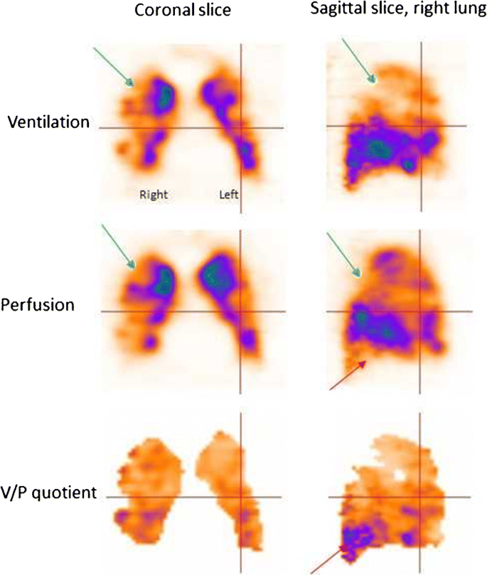 EANM guideline for ventilation/perfusion single-photon emission computed  tomography (SPECT) for diagnosis of pulmonary embolism and beyond |  SpringerLink