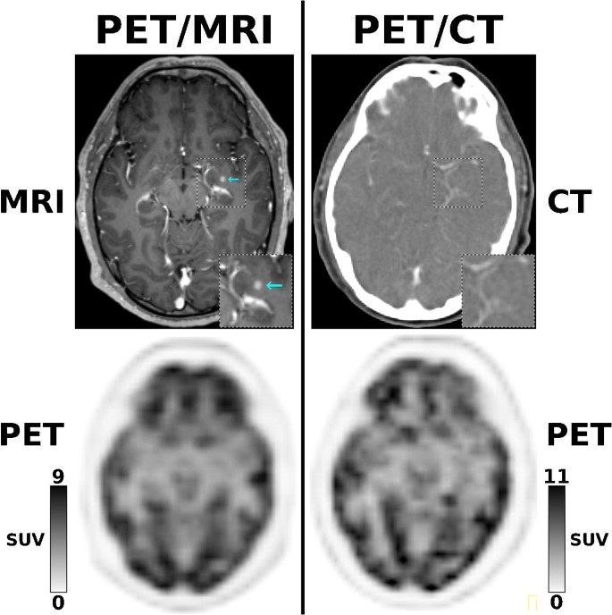 PET/MRI versus PET/CT in oncology: a prospective single-center study of examinations on implications for patient management and cost considerations | SpringerLink