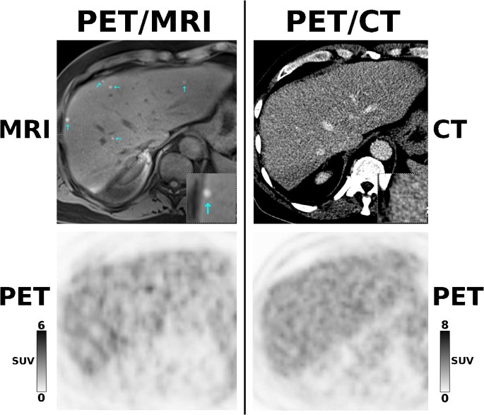 PET/MRI versus PET/CT in oncology: a prospective single-center study of 330  examinations focusing on implications for patient management and cost  considerations | SpringerLink