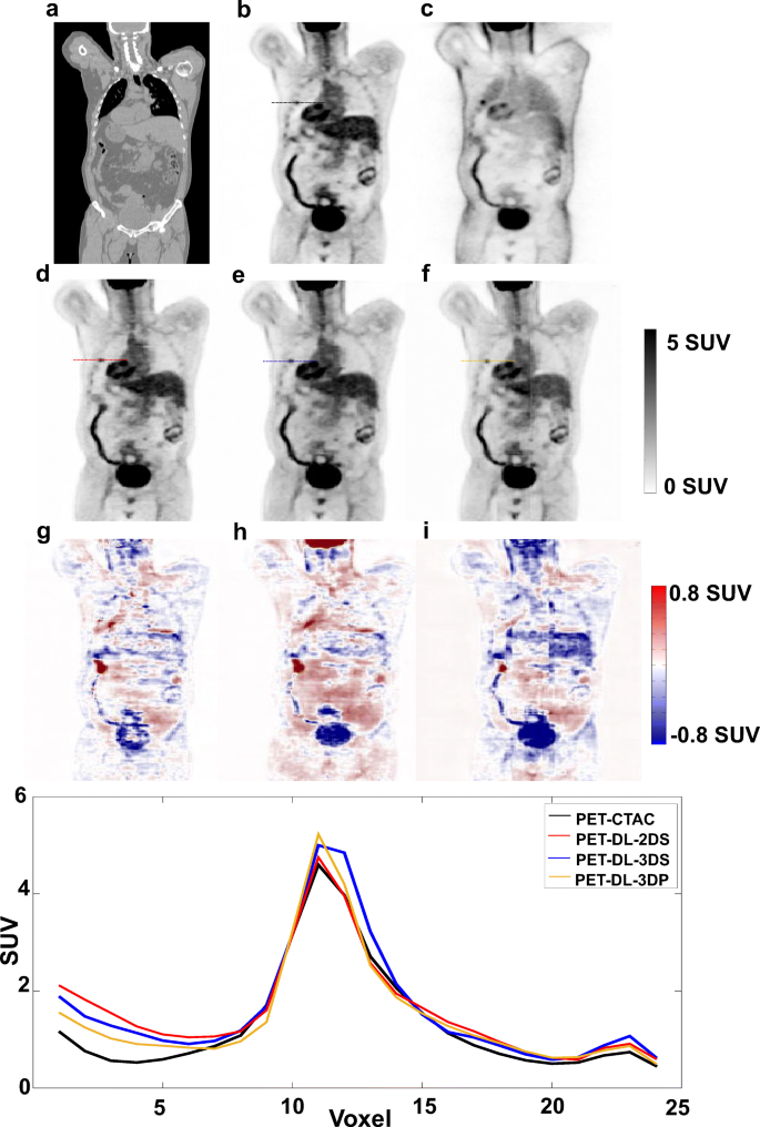 Deep Jasc Joint Attenuation And Scatter Correction In Whole Body 18 F Fdg Pet Using A Deep Residual Network Springerlink