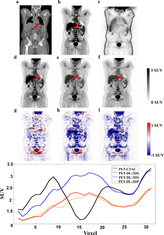 Deep Jasc Joint Attenuation And Scatter Correction In Whole Body 18 F Fdg Pet Using A Deep Residual Network Springerlink