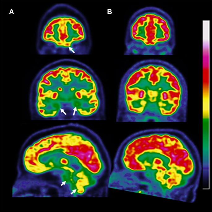 2-[18F]-FDG PET for brain patients long COVID: perspective of the EANM Neuroimaging Committee | SpringerLink