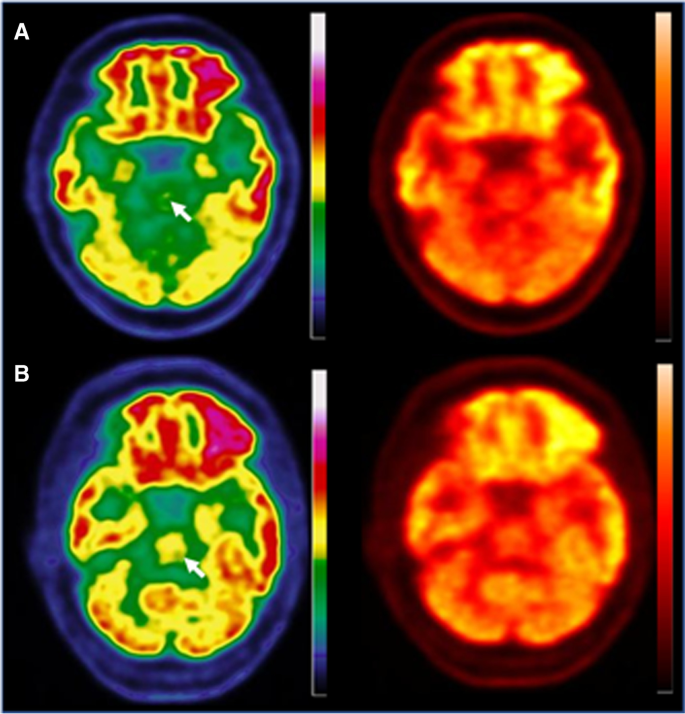 2-[18F]-FDG PET for brain patients long COVID: perspective of the EANM Neuroimaging Committee | SpringerLink