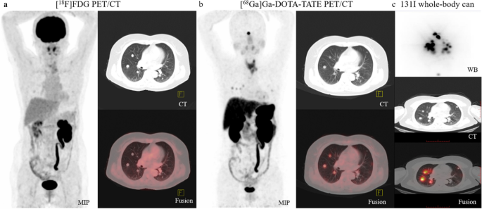 PET/CT comparing (68)Ga-DOTATATE and other radiopharmaceuticals for the ...
