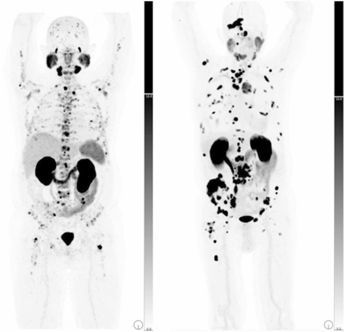Effect of bone marrow disease on hematologic toxicity and response to ...
