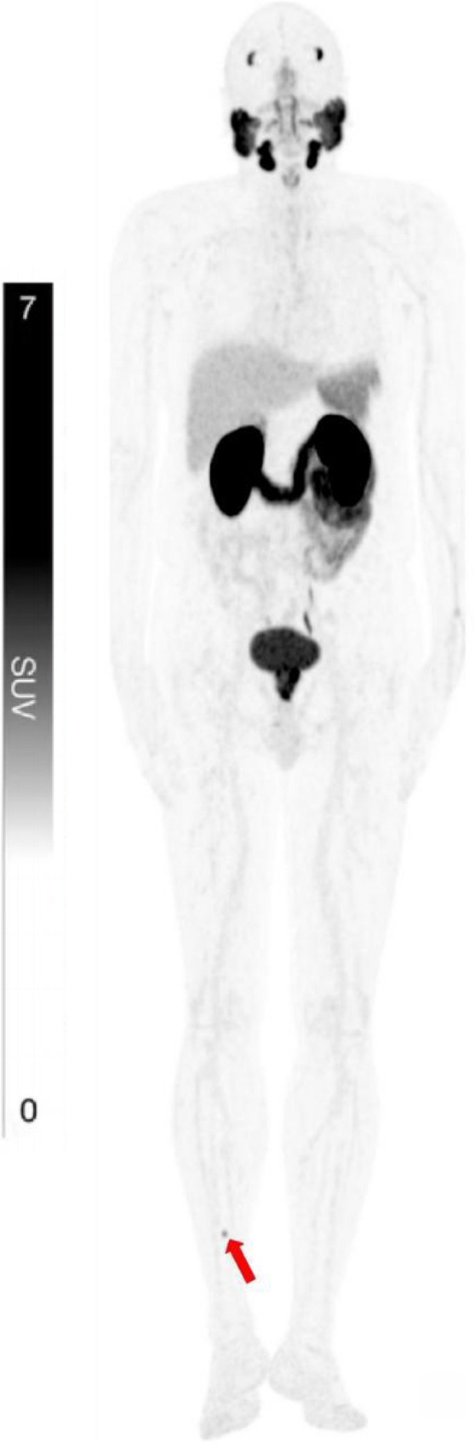 The clinical utility of total-body [68 Ga]Ga-PSMA-11 PET/CT in prostate ...