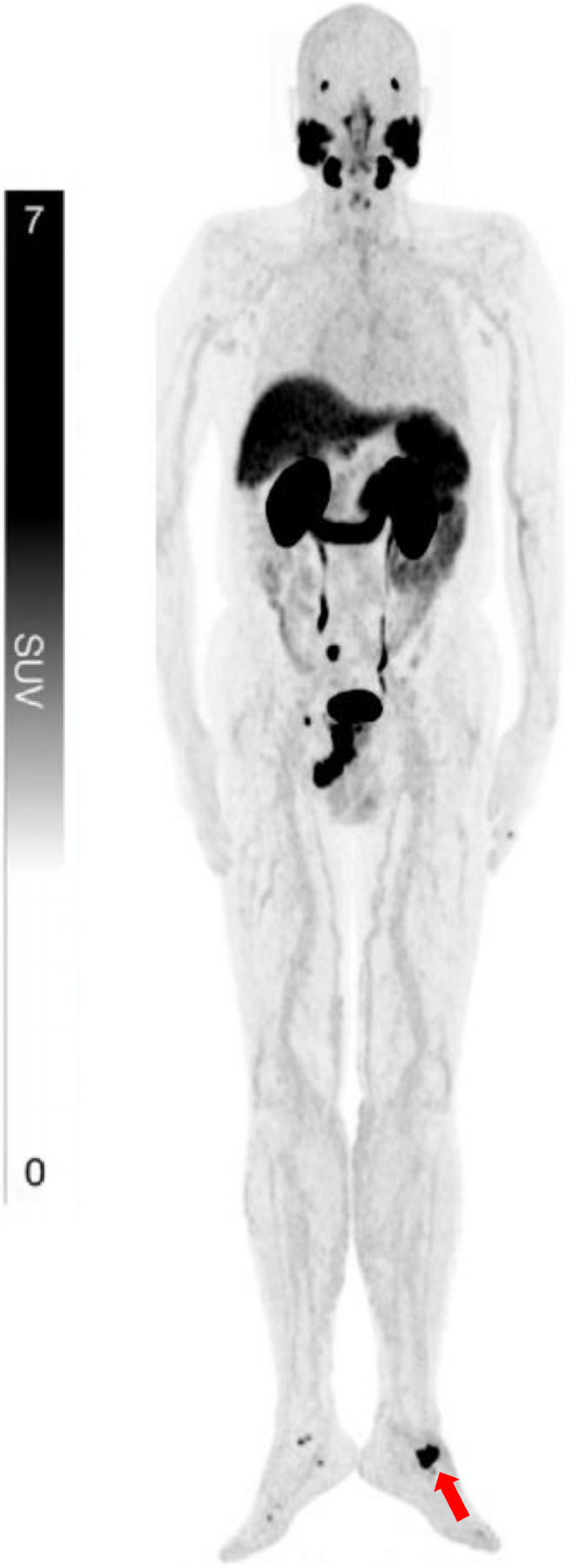 The clinical utility of total-body [68 Ga]Ga-PSMA-11 PET/CT in prostate ...