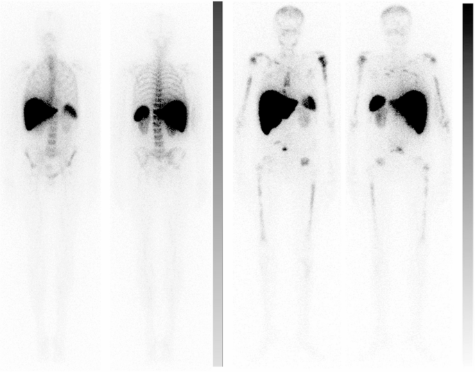 Bone marrow scintigraphy as a prognostic marker of overall survival in ...