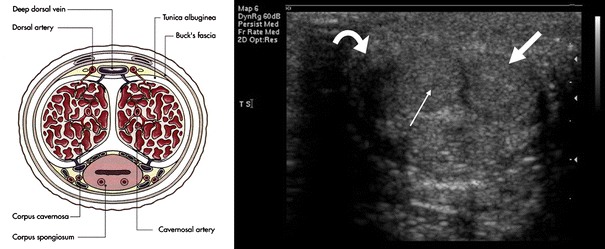 Erectile Dysfunction The Role Of Penile Doppler Ultrasound In Diagnosis Springerlink
