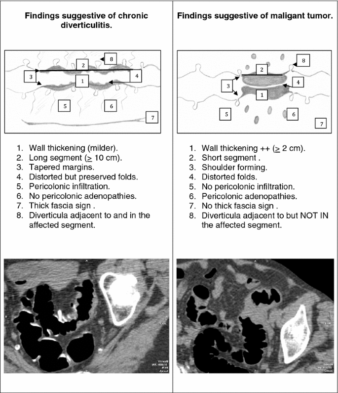 Chronic Diverticulitis Vs. Colorectal Cancer: Findings On Ct Colonography |  Springerlink