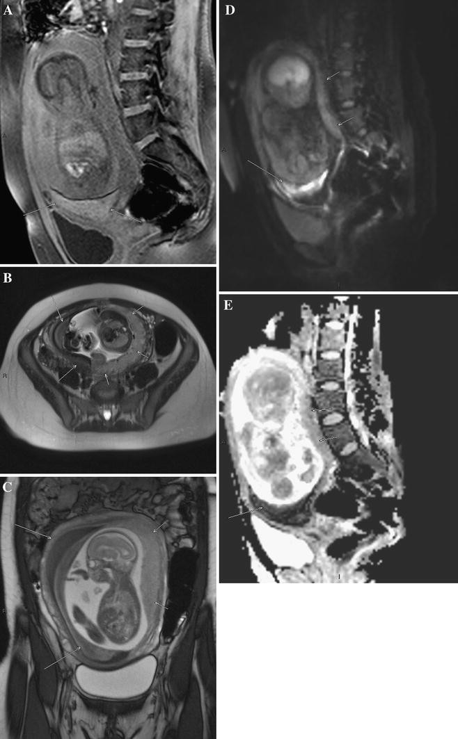 MR imaging of placenta: what radiologist should know | SpringerLink