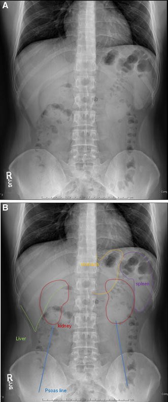 Abdominal Radiograph Pearls And Pitfalls For The Emergency Department Radiologist A Pictorial Review Springerlink Abdominal Radiograph Pearls And Pitfalls For The Emergency Department Radiologist A Pictorial Review Springerlink