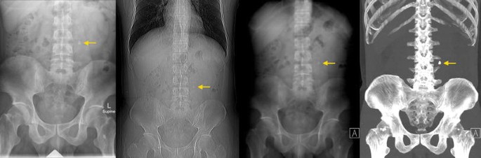 Alternatives To The Baseline Kub For Ctkub Detected Calculi Evaluation Of Ct Scout And Average And Maximum Intensity Projection Images Springerlink