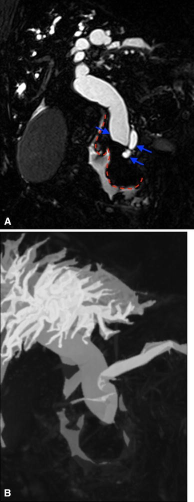 Inverted Figure 3” sign of periampullary carcinoma | SpringerLink