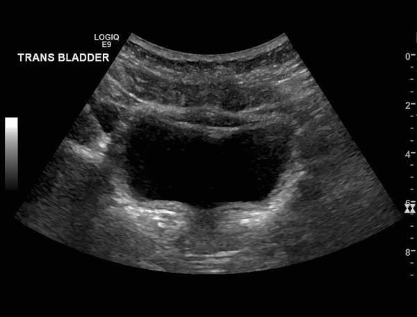 Bladder Debris On Ultrasound In The Emergency Department Correlation With Urinalysis Springerlink