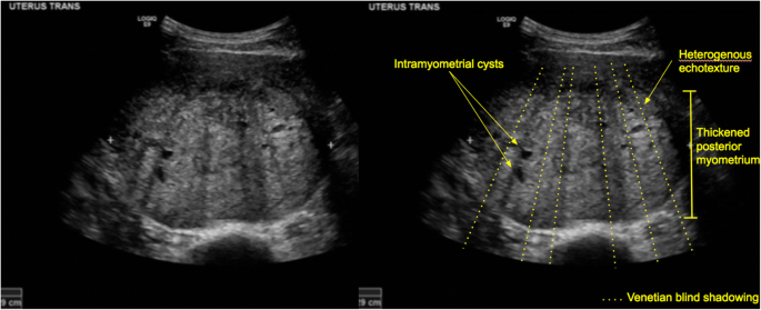 Venetian Blind Shadowing On Ultrasound Springerlink