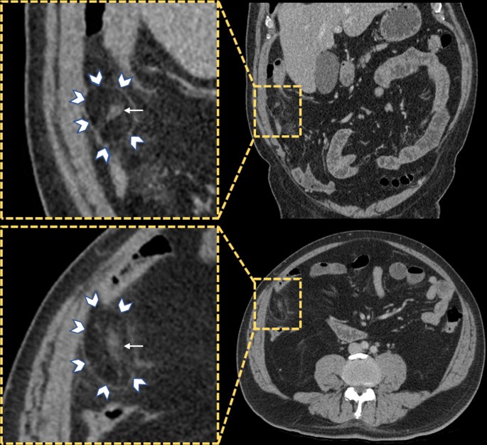 The central dot sign of epiploic appendagitis | SpringerLink The central dot sign of epiploic appendagitis | SpringerLink
