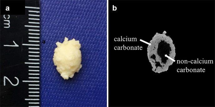 Quantification And Differentiation Of Composition Of Mixed Pancreatic Duct  Stones Using Single-Source Dual-Energy Ct: An Ex Vivo Study | Springerlink