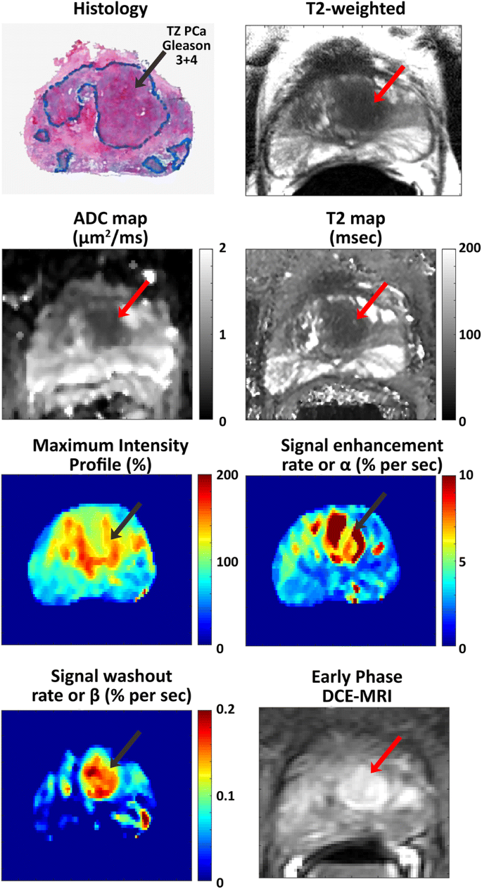 Revisiting Quantitative Multi Parametric Mri Of Benign Prostatic Hyperplasia And Its Differentiation From Transition Zone Cancer Springerlink