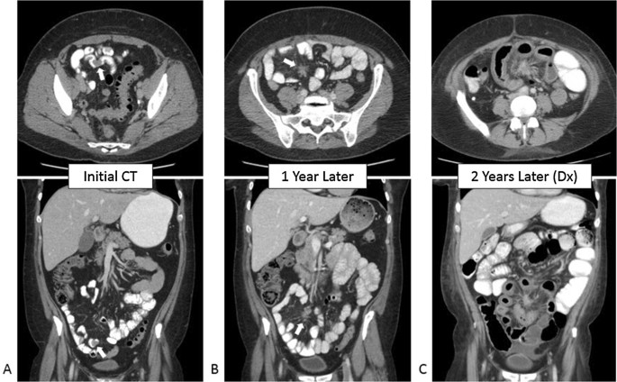 Carcinoma, Tumor CT detection of primary and metastatic ileal carcinoid tumor-Carcinoid-Tumors-Cancer-Symptoms-Diagnosis-Treatment-Homeopathic-Allopathic-Best Homeopathic-Doctor-Pakistan-Dr-Qaisar-Ahmed