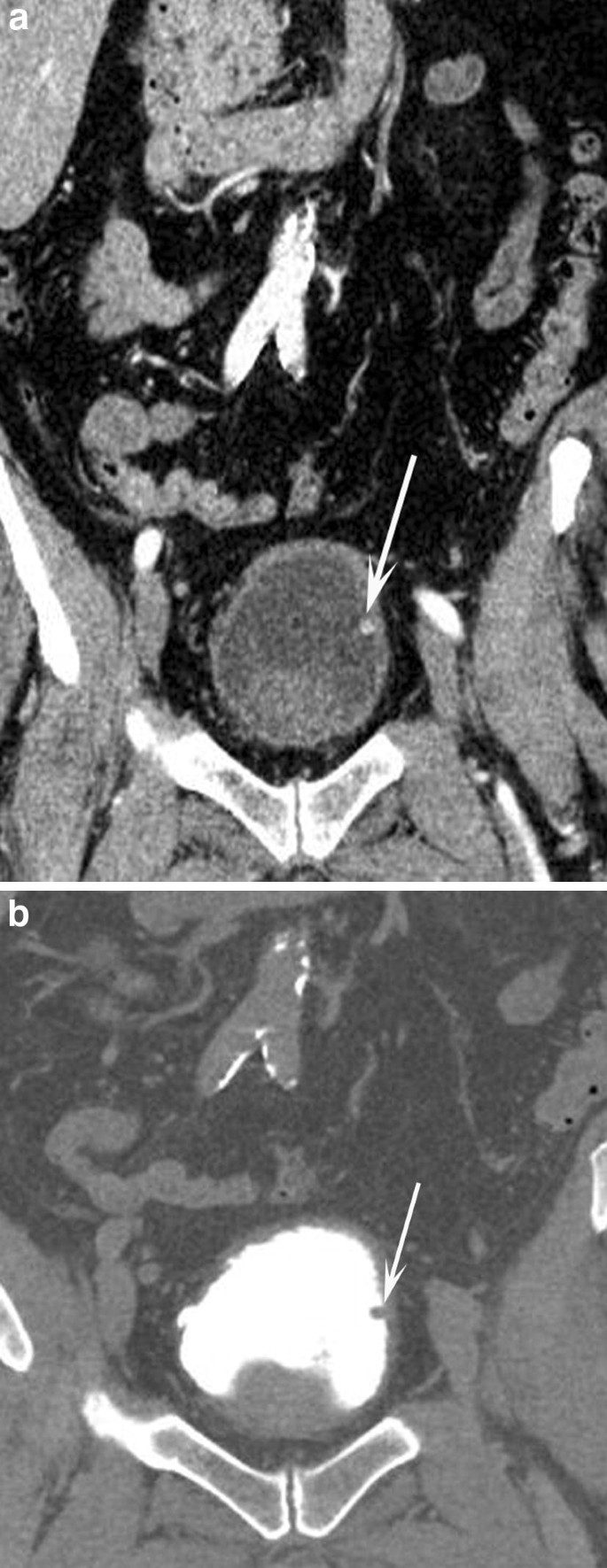 Tumorile vezicale , Urinary bladder papilloma ct