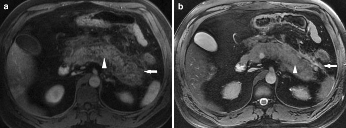 MRI in acute pancreatitis | SpringerLink