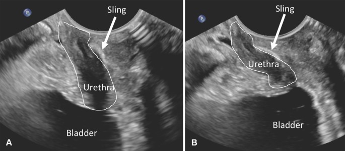 Imaging of the female urethra | SpringerLink Imaging of the female urethra | SpringerLink