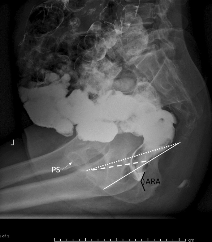 Multimodality Imaging Of Pelvic Floor Anatomy Springerlink
