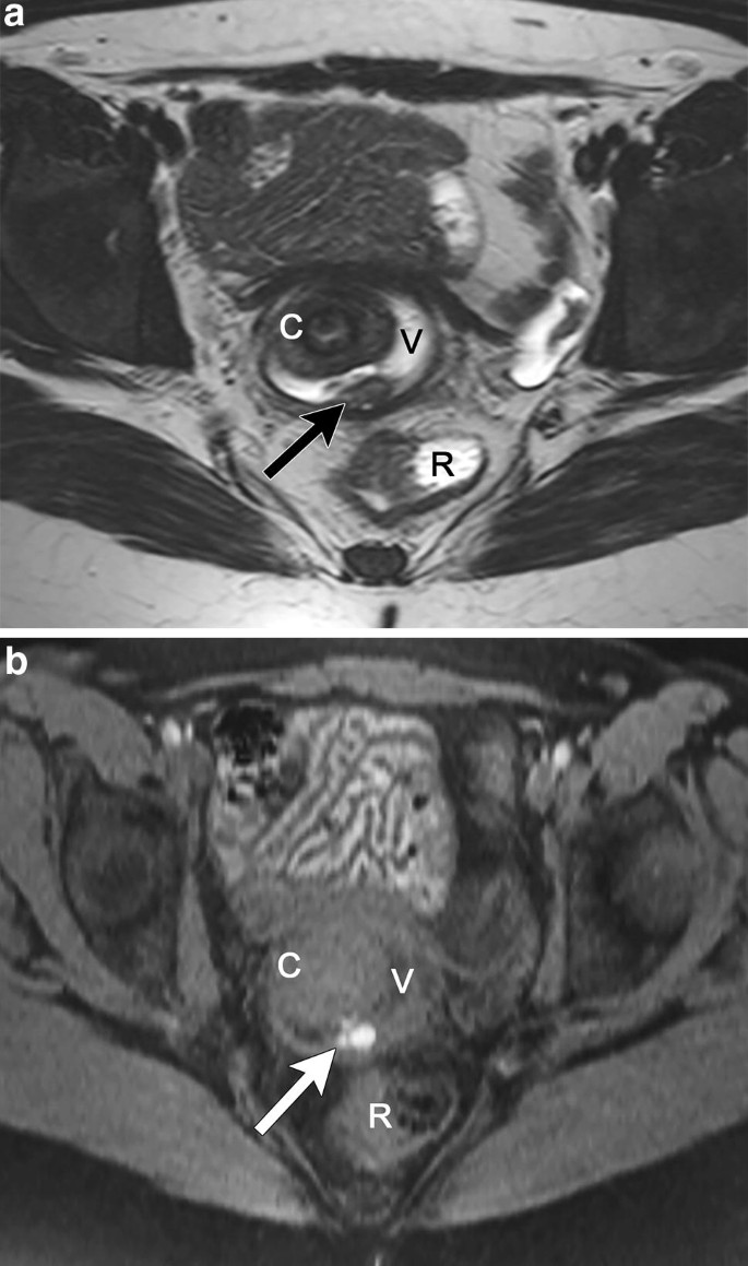 15+ Endometriosis Mri Images Gif