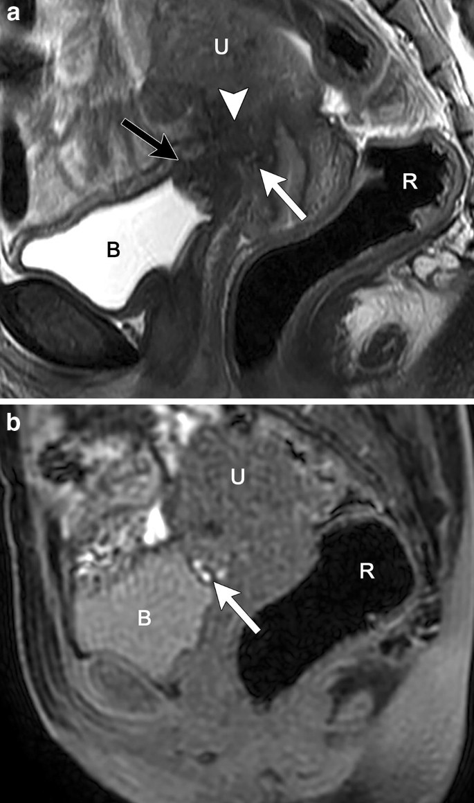 Endometriosis Mri Lexicon Consensus Statement From The Society Of Abdominal Radiology Endometriosis Disease Focused Panel Springerlink