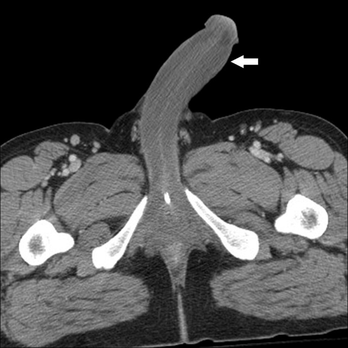 MRI of the penis | SpringerLink