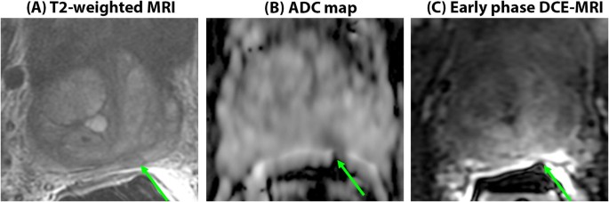 prostate mri pitfalls